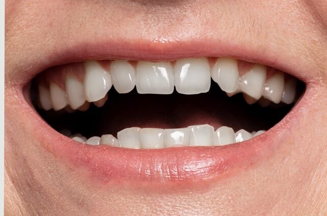 teeth whitening before and after.