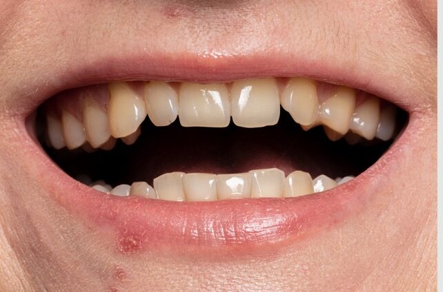 teeth whitening before and after teeth whitening before and after.